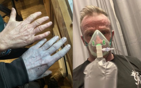 Si sveglia con la pelle completamente blu come un Puffo: panico in ospedale, ma la verità è incredibile